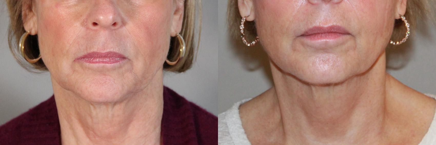 Before & After Sculptra® Case 153 Front View in Atlanta, Georgia
