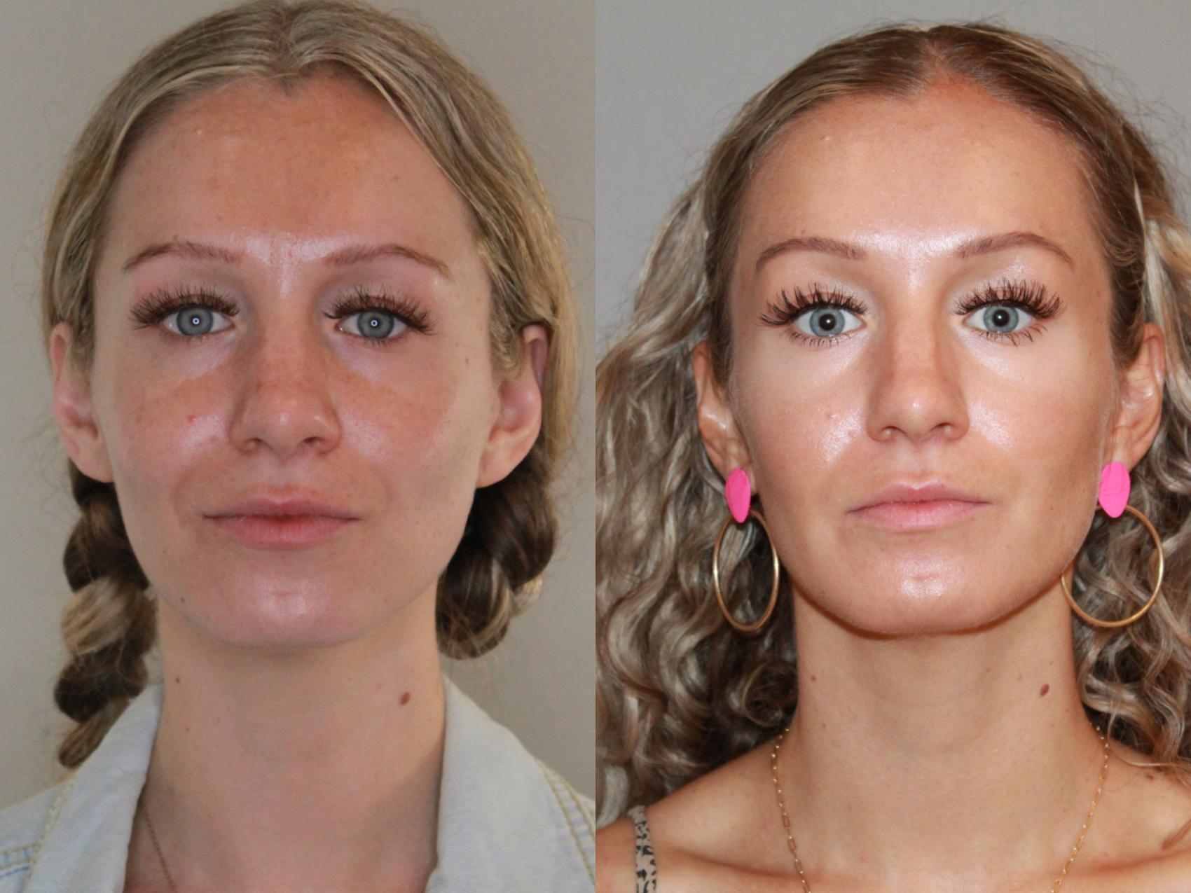 Before & After Sculptra® Case 159 Front View in Atlanta, Georgia