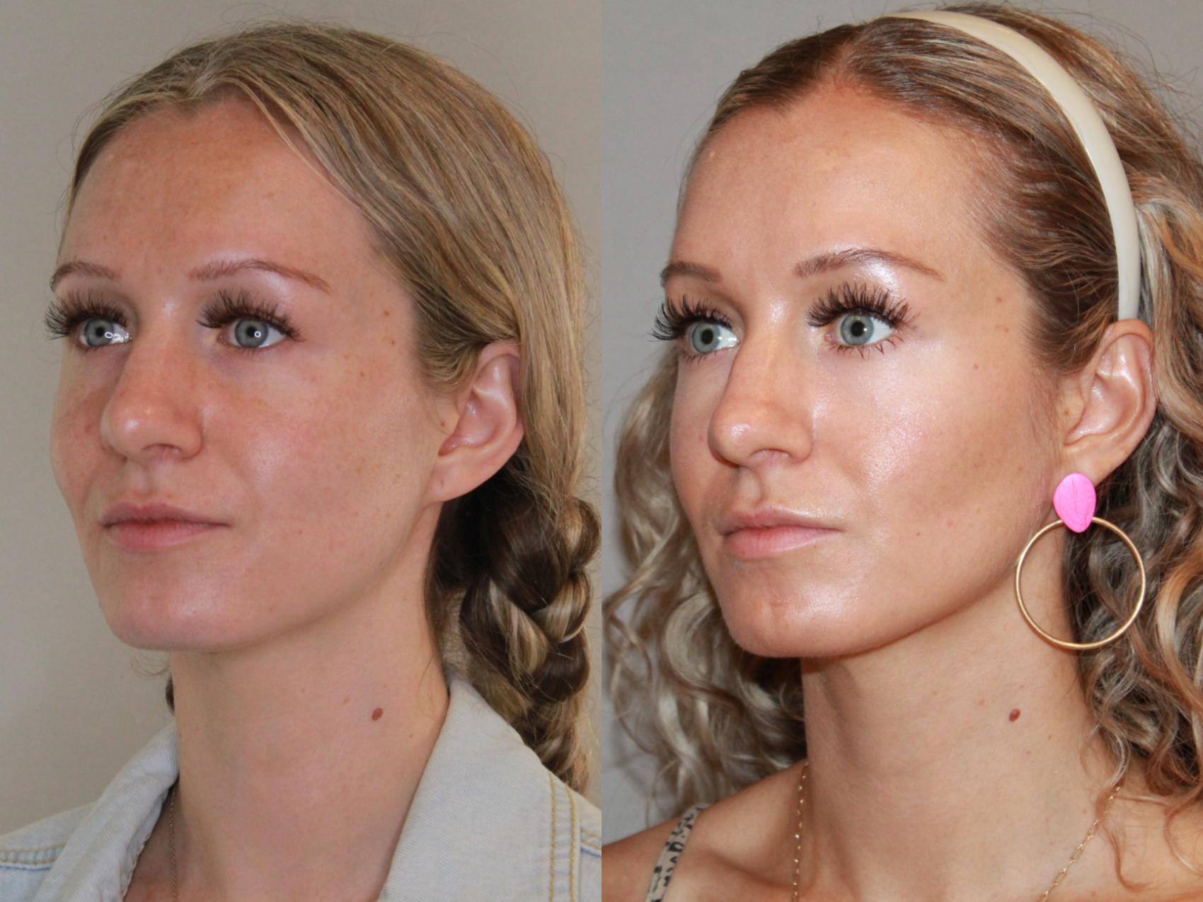 Sculptra® Before And After Pictures Case 159 Atlanta Georgia Buckhead Facial Plastic Surgery 6186