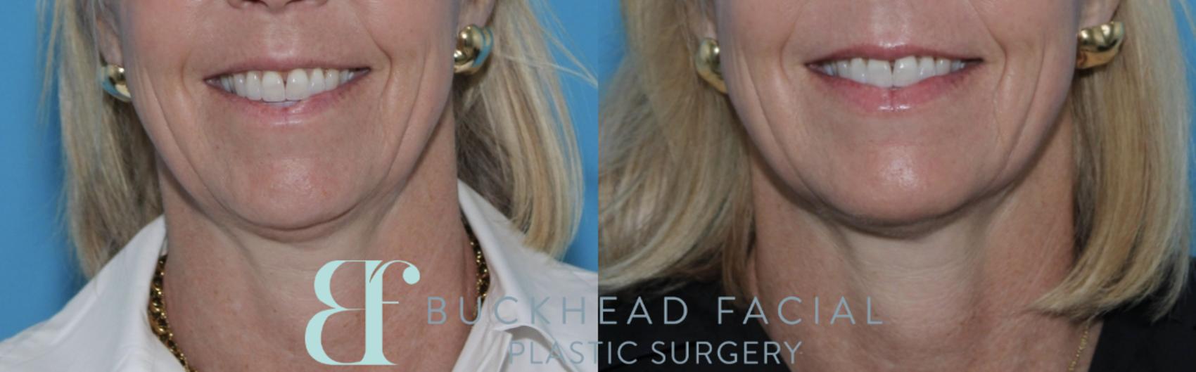 Beautiful lower face Sculptra for collagen repletion and neurotoxin for softening downward pull of mouth, chin, and neck by Ashlie Walsh, PA-C