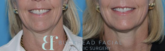 Beautiful lower face Sculptra for collagen repletion and neurotoxin for softening downward pull of mouth, chin, and neck by Ashlie Walsh, PA-C