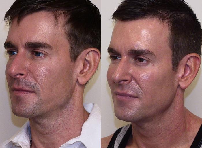 Before & After Sculptra® Case 24 View #1 View in Atlanta, Georgia
