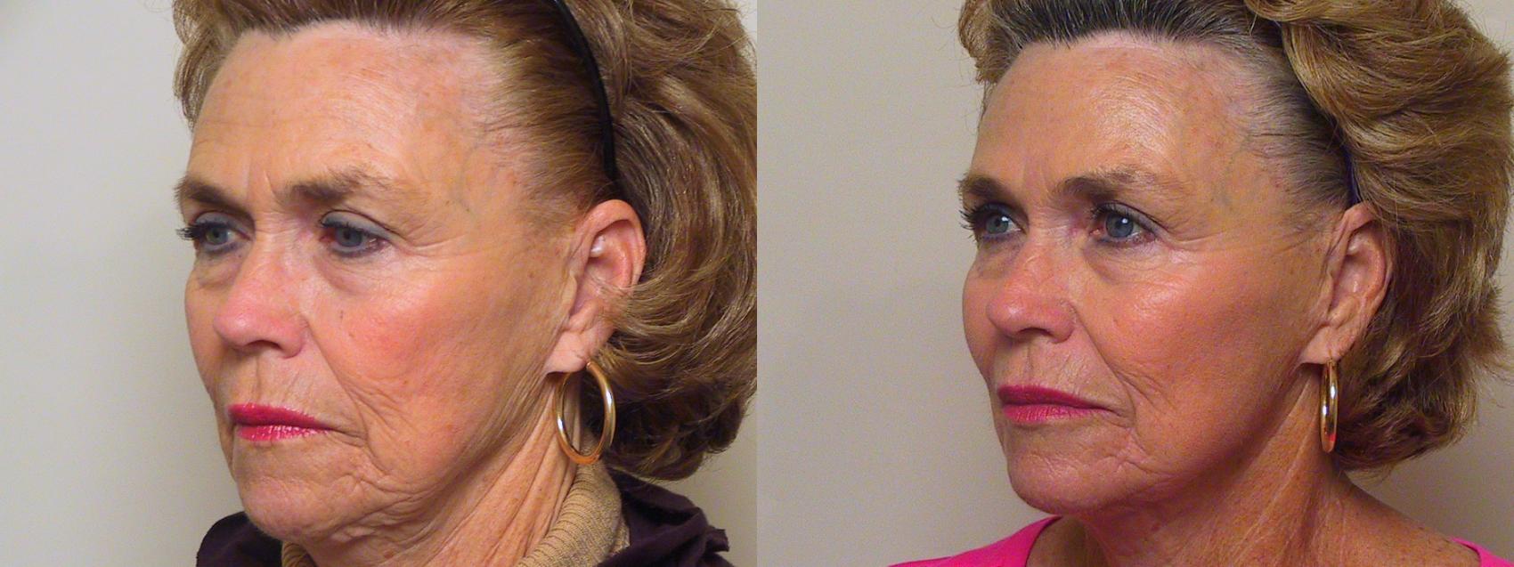 Before & After Sculptra® Case 31 View #1 View in Atlanta, Georgia