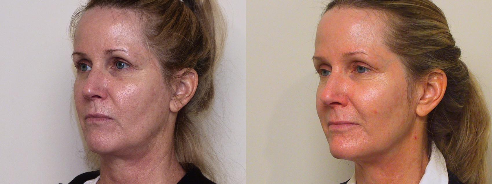 Before & After Sculptra® Case 32 View #1 View in Atlanta, Georgia