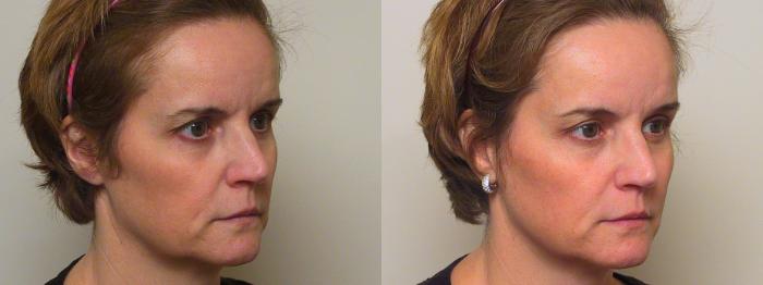 Before & After Sculptra® Case 36 View #1 View in Atlanta, Georgia