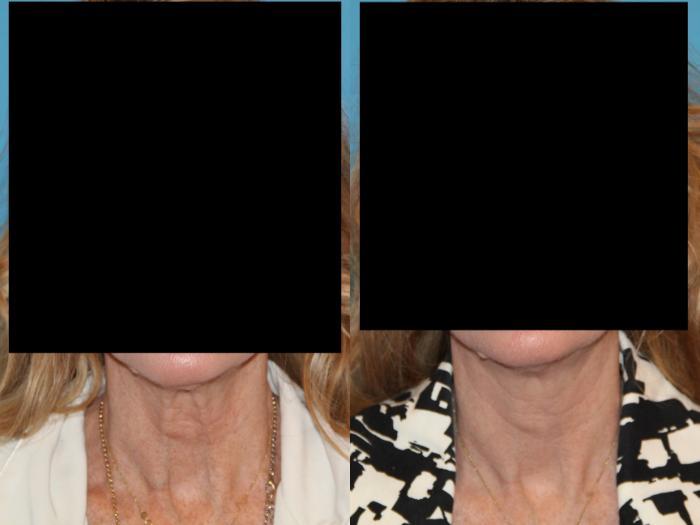 Before & After Sculptra® Case 88 View #1 View in Atlanta, Georgia