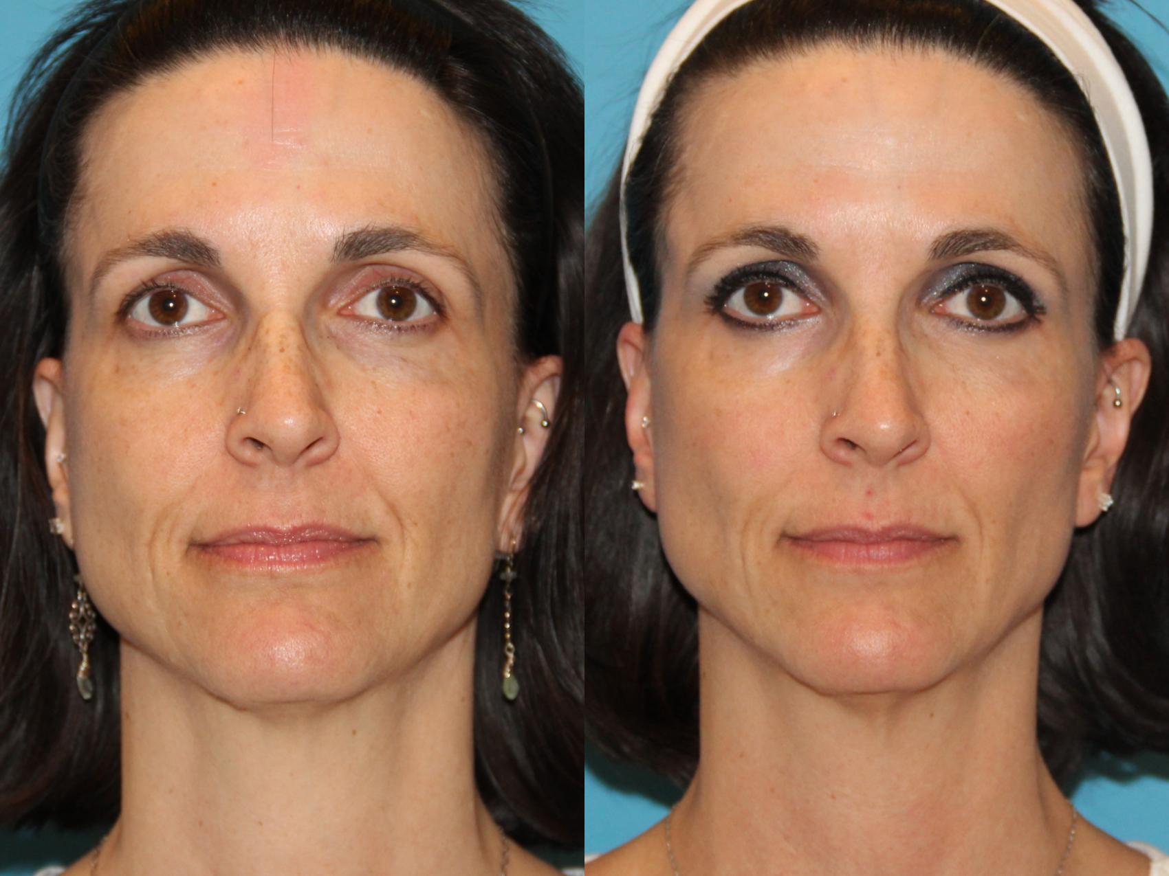 Before & After Sculptra® Case 98 View #1 View in Atlanta, Georgia