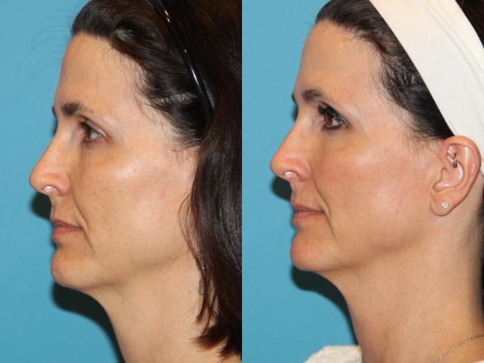 Before & After Sculptra® Case 98 View #3 View in Atlanta, Georgia