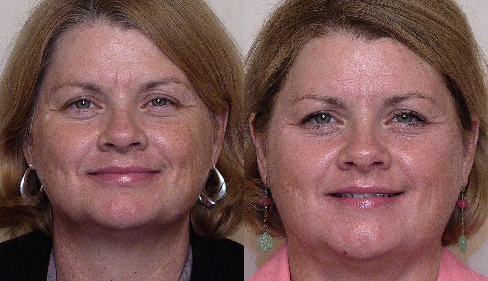 Before & After Skin Care Case 11 View #1 View in Atlanta, Georgia