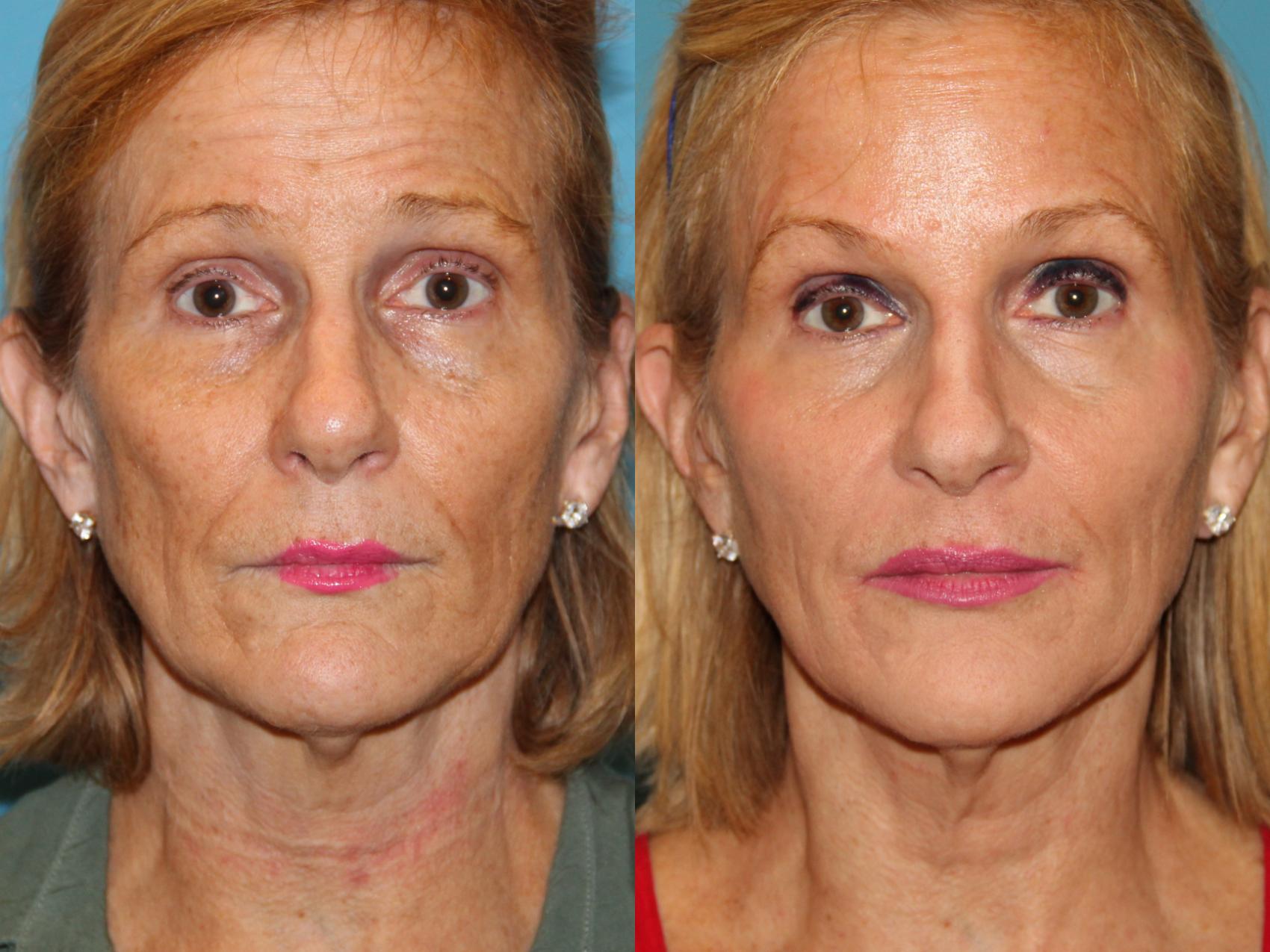 Before & After Skin Care Case 112 View #1 View in Atlanta, Georgia