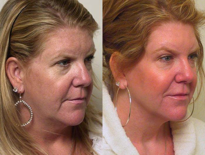 Before & After Skin Care Case 23 View #1 View in Atlanta, Georgia