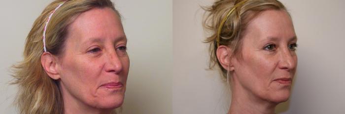 Before & After Skin Care Case 33 View #1 View in Atlanta, Georgia