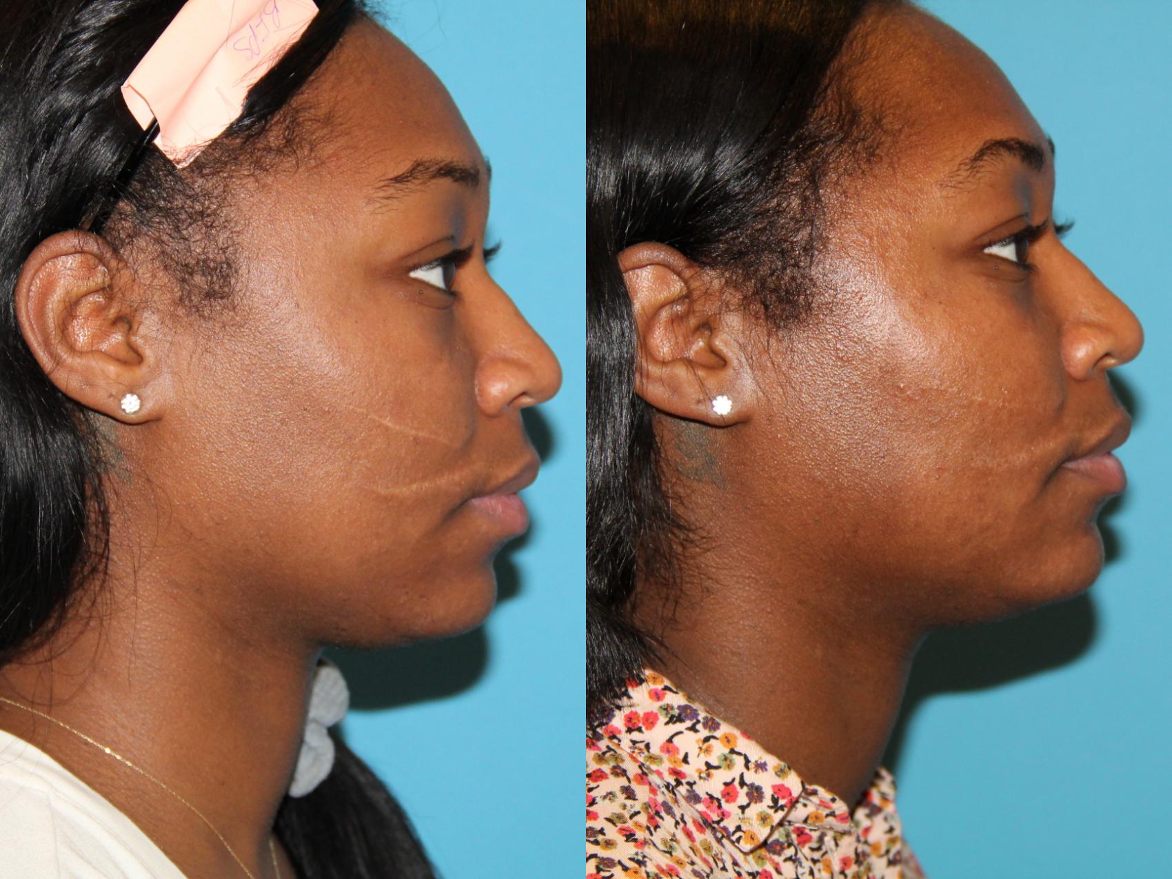 Before & After Skin Care Case 90 View #1 View in Atlanta, Georgia