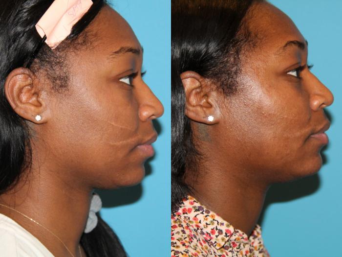 Before & After Skin Care Case 90 View #1 View in Atlanta, Georgia