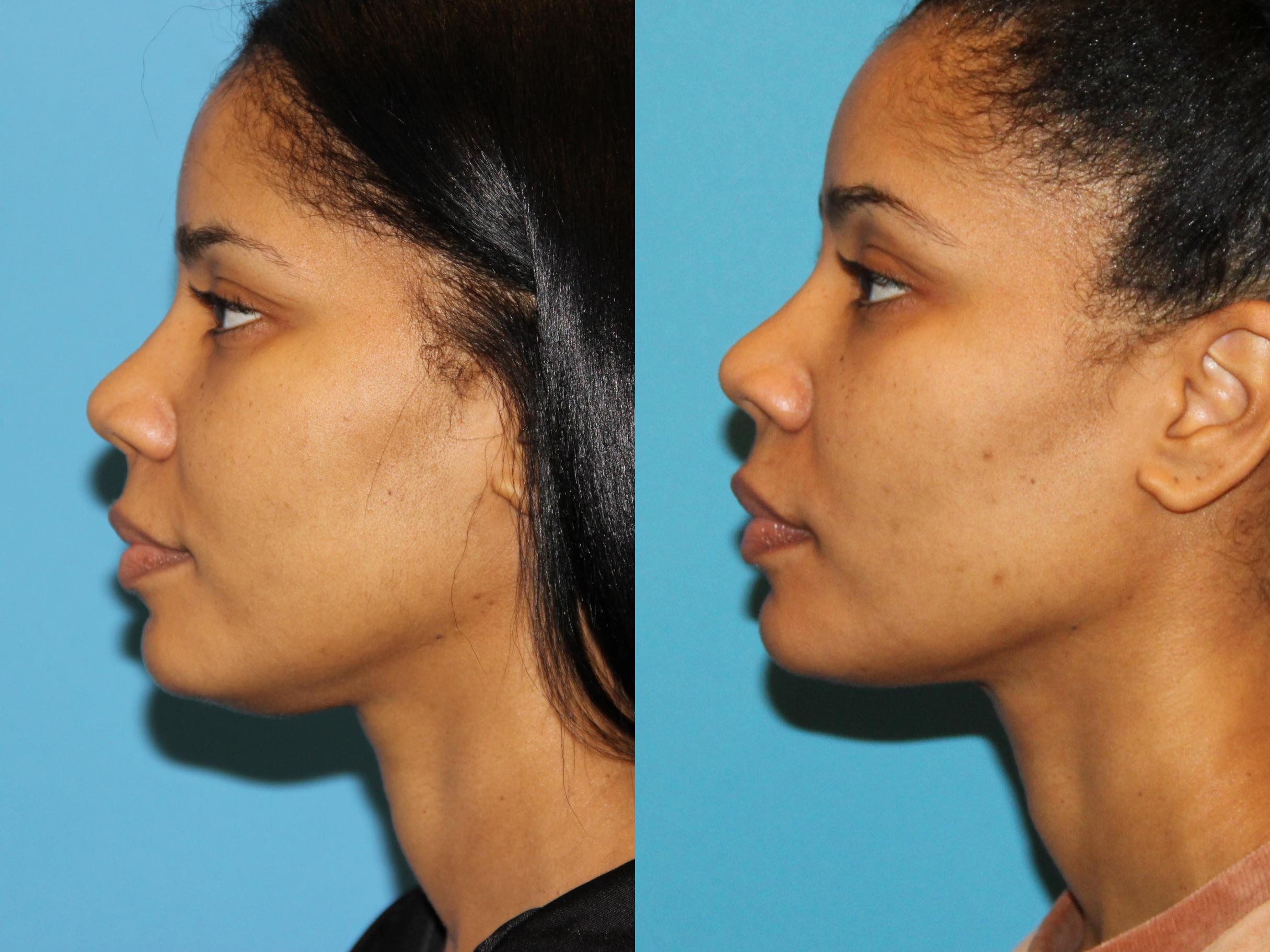 neck-lift-submentoplasty-before-and-after-pictures-case-94-atlanta