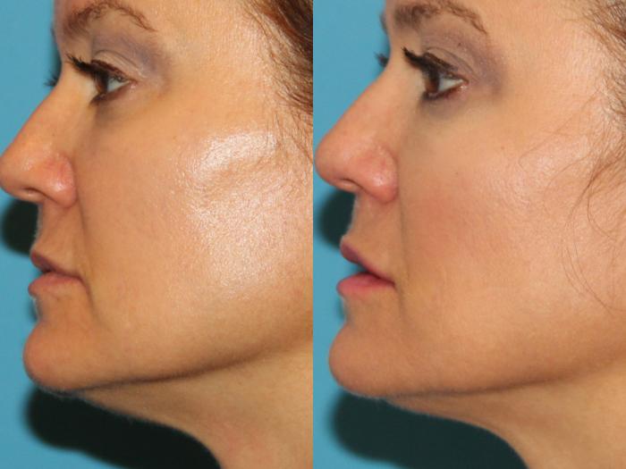 Before & After Ultherapy® Case 128 View #1 View in Atlanta, Georgia