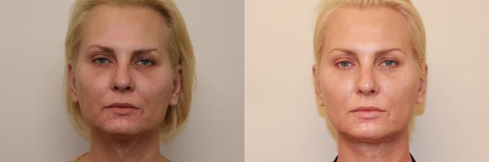 Before & After Ultherapy® Case 53 View #2 View in Atlanta, Georgia